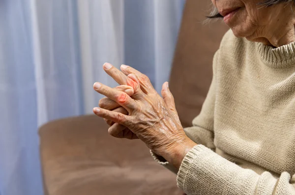 Rheumatoid Arthritis