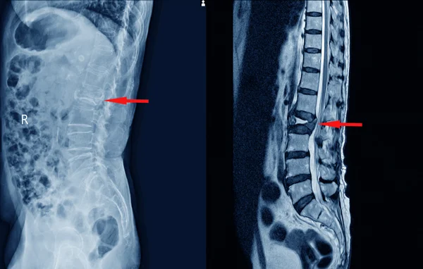 Disc Bulge