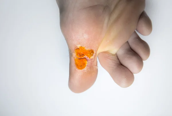 Diabetic Foot Ulcers